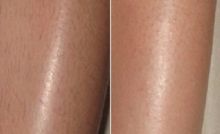 лазерная эпиляция рук