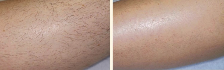 Эпиляция рук лазером отзыв