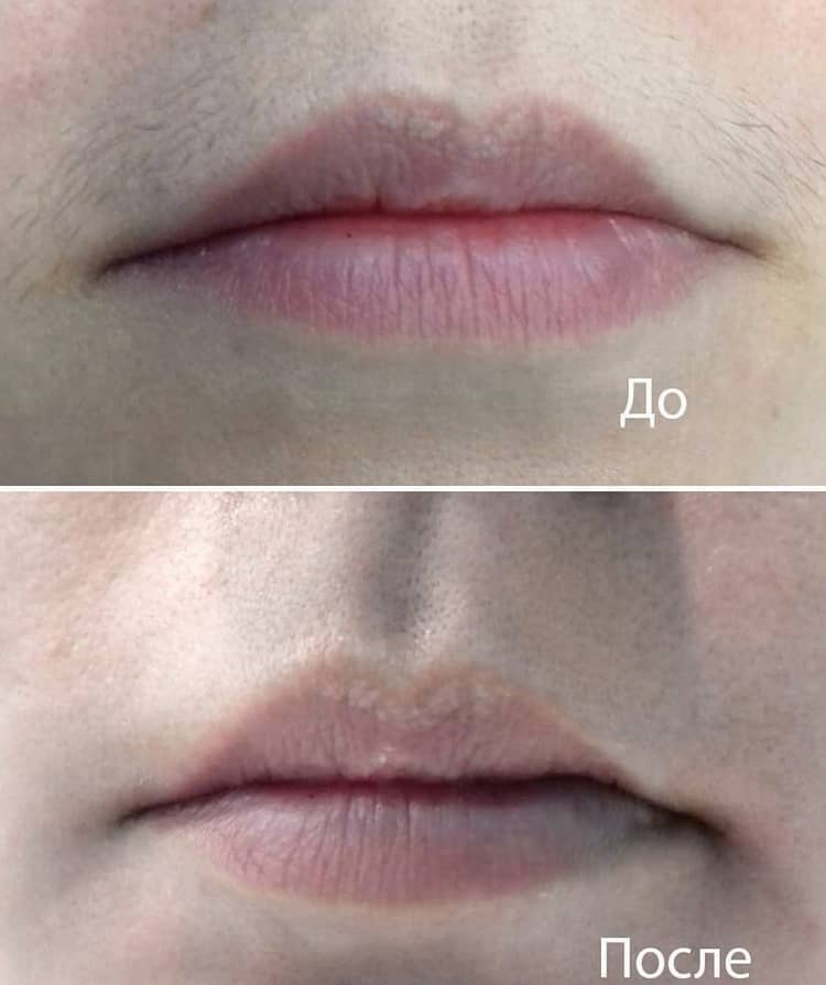 лазерная эпиляция отзывы фото до и после