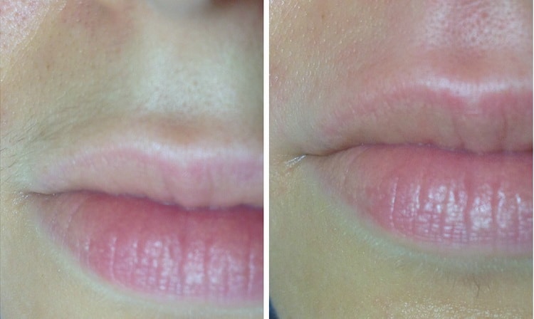 лазерная эпиляция лица отзывы